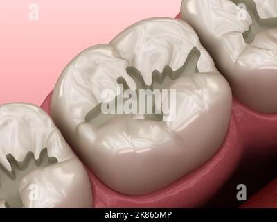 Präparierte Molar-Fissur für Füllungen Platzierung, medizinisch genaue 3D Illustration des Zahnkonzepts Stockfoto