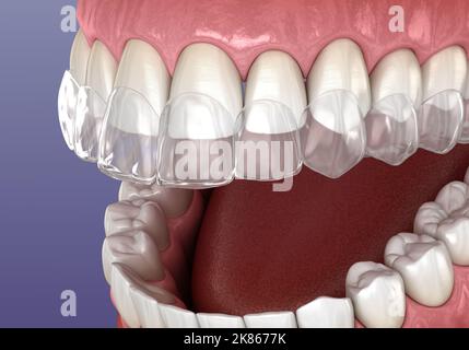 Invisalign-Klammern oder unsichtbare Halterung. Medizinisch genaue zahnärztliche 3D Illustration Stockfoto