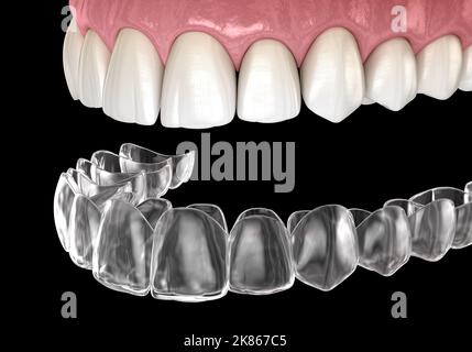 Invisalign-Klammern oder unsichtbare Halterung. Medizinisch genaue zahnärztliche 3D Illustration Stockfoto