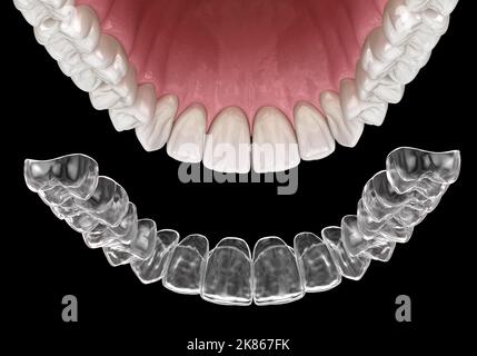 Invisalign-Klammern oder unsichtbare Halterung. Medizinisch genaue zahnärztliche 3D Illustration Stockfoto