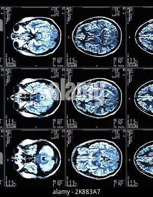 Ein MRT-Gehirn scannt einen Patienten mit Multipler Sklerose Stockfoto