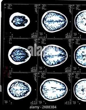 Ein MRT-Gehirn scannt einen Patienten mit Multipler Sklerose Stockfoto