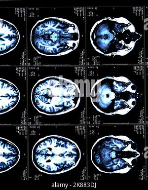 Ein MRT-Gehirn scannt einen Patienten mit Multipler Sklerose Stockfoto