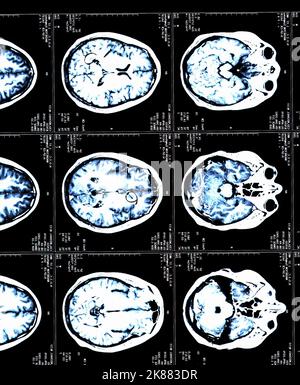 Ein MRT-Gehirn scannt einen Patienten mit Multipler Sklerose Stockfoto