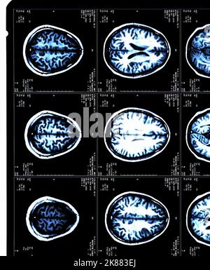 Ein MRT-Gehirn scannt einen Patienten mit Multipler Sklerose Stockfoto