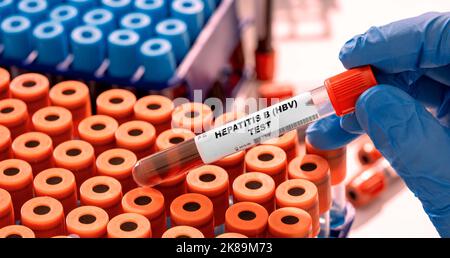 Hepatitis-B-Bluttest, konzeptuelles Bild Stockfoto