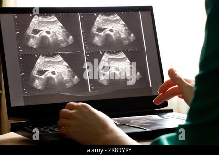 Ultraschall des Abdomens einer Frau auf einem Laptop-Monitor in einer Arztpraxis, Diagnose von Bauchschmerzen, Medizin Stockfoto