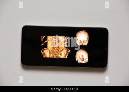 Computertomographie der Wirbelsäule eines alten Mannes mit Osteochandrose mit einem gebrochenen Wirbel und deren Verschiebung und einem Schädel mit einem gebrochenen für Stockfoto