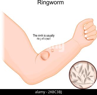 Ringwurm am menschlichen Arm. Pilzinfektion der Haut. Nahaufnahme eines Pilzes, der Krankheit verursacht hat. vektordarstellung Stock Vektor