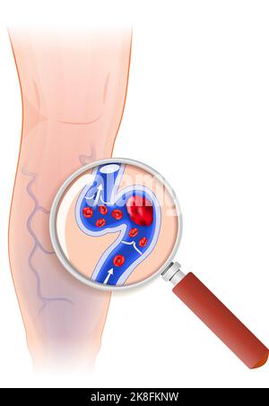 Das menschliche Bein ist von Krampfadern betroffen. Blaues Blutgefäß, das durch die Haut sichtbar ist. Querschnitt der Krampfader durch eine Lupe Stock Vektor