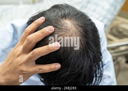 Glatze in der Mitte Kopf und beginnen keinen Verlust Haar glabrous der reifen asiatischen Geschäft smart aktiven Büromann. Stockfoto