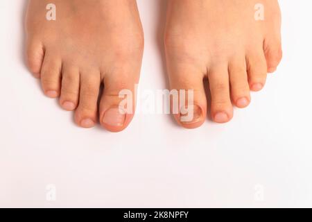 Draufsicht auf einen Fuß und einen Zehennagel mit Pilz auf weißem Hintergrund. Nagel mit Pilzerkrankungen betroffen Stockfoto