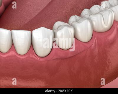 Partiell abnehmbare sofort-Prothese Typ Schmetterling. Ersatz eines fehlenden Zahns 3D Abbildung Stockfoto