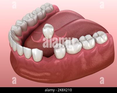 Partiell abnehmbare sofort-Prothese Typ Schmetterling. Ersatz eines fehlenden Zahns 3D Abbildung Stockfoto