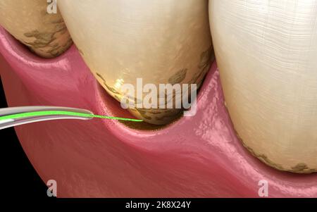 Laser entfernt eine dünne Schicht der infizierten Haut, Zahnreinigung. Medizinisch akkurate Zahn 3D Abbildung Stockfoto