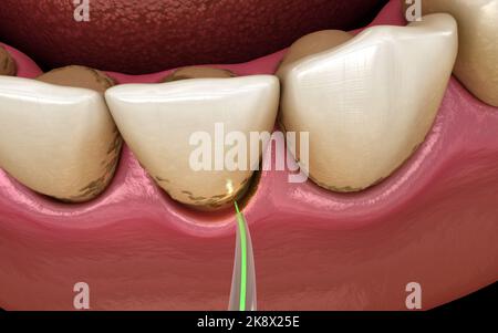 Laser entfernt eine dünne Schicht der infizierten Haut, Zahnreinigung. Medizinisch akkurate Zahn 3D Abbildung Stockfoto