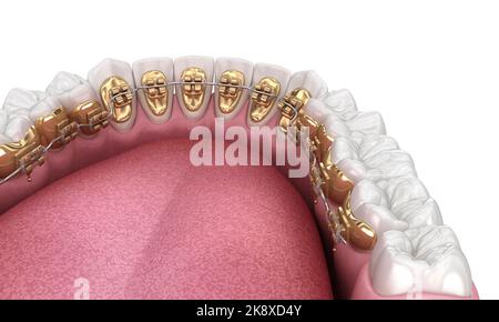 Gesunde Zähne mit goldenen Zahnspangen, weißes Zahnkonzept, dental 3D Illustration Stockfoto