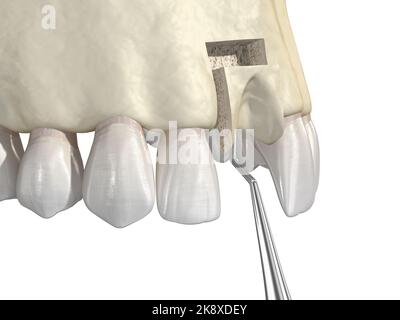 Knochentransplantation - Augmentation mit Knochenblock, Zahnimplantation. Medizinisch genaue 3D-Darstellung Stockfoto