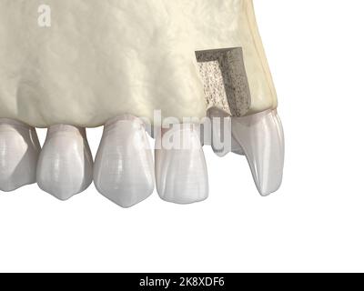 Knochentransplantation - Augmentation mit Knochenblock, Zahnimplantation. Medizinisch genaue 3D-Darstellung Stockfoto