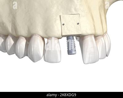 Knochentransplantation - Augmentation mit Knochenblock, Zahnimplantation. Medizinisch genaue 3D-Darstellung Stockfoto