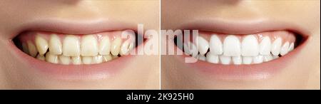 Frau Zähne vor und nach dem Aufhellen. Perfektes Lächeln mit gesunden Zähnen. Patient Der Zahnklinik. Zahnmedizin und Stomatologie Stockfoto