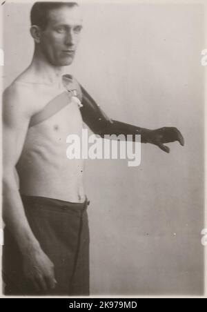 Fotografie aus „ein Bericht über die Herstellung in der Prothesenwerkstatt der Staatsbahn in Nässjö“, 1932. Visces die Fähigkeit der Armprothese zu bewegen und Benutzerfreundlichkeit. Stockfoto