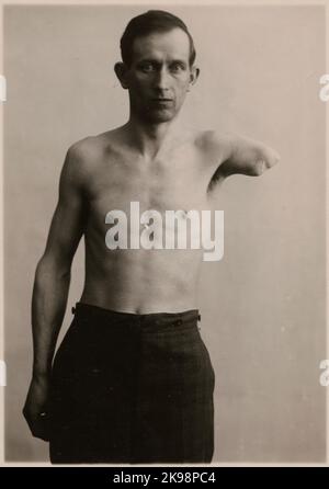 Fotografie aus „ein Bericht über die Herstellung in der Prothesenwerkstatt der Staatsbahn in Nässjö“, 1932. Mann mit ampuiertem Arm, um eine Prothese von der Prothesenwerkstatt in Nässjö herstellen zu lassen. Stockfoto