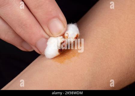 Kauterisierung einer Wunde am Arm mit Jodlösung und Watte, Gesundheit Hautpflege. Stockfoto