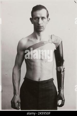 Fotografie aus „ein Bericht über die Herstellung in der Prothesenwerkstatt der Staatsbahn in Nässjö“, 1932. Visces die Fähigkeit der Armprothese zu bewegen und Benutzerfreundlichkeit. Stockfoto