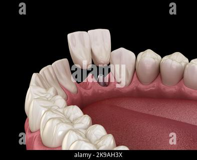 Cantilever Bridge Implantat basiert, frontale Zahnwiederherstellung. Medizinisch akkurate 3D Animation des Zahnkonzepts Stockfoto