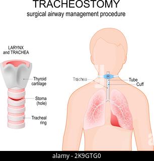 Tracheostomie. Chirurgisches Atemwegsmanagement. Anatomie der Trachea mit Stoma. Kehlkopf. Menschliche Silhouette mit Lunge, Trachea, Bronchien Stock Vektor