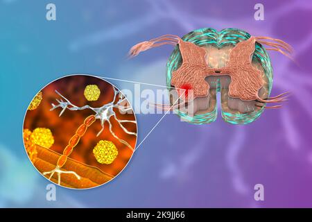 Polio-Viren, die Motoneuronen beeinflussen, Illustration Stockfoto