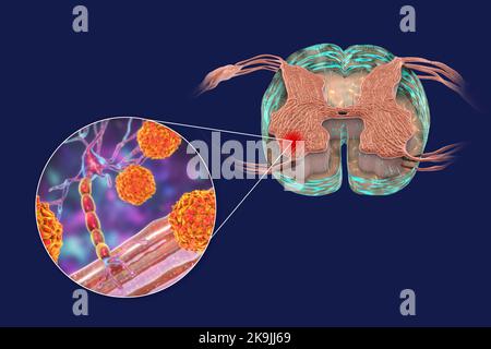 Polio-Viren, die Motoneuronen beeinflussen, Illustration Stockfoto