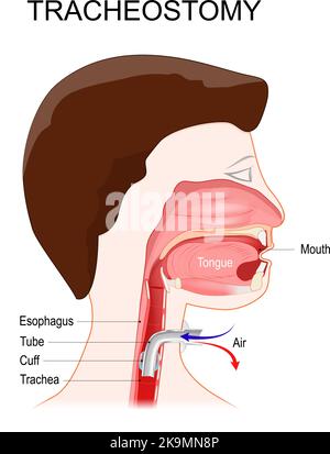 Tracheotomie. Seitenansicht des Halses und korrekte Platzierung eines Tracheostomieschlauchs in der Trachea. Das Stoma für einen Trachealtubus oder Tracheostomietubus Stock Vektor