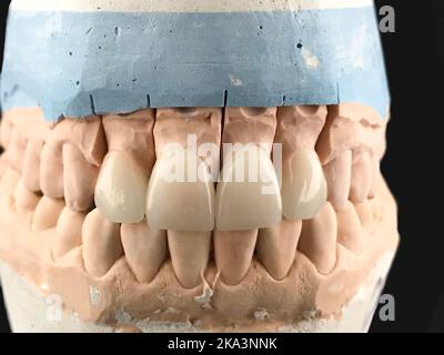 Dental Kiefergegossen Modell und zahnärztliche Ausrüstung auf schwarzem Hintergrund, Konzept medizinische Bild der zahnärztlichen Versorgung, Zahnhygiene Stockfoto