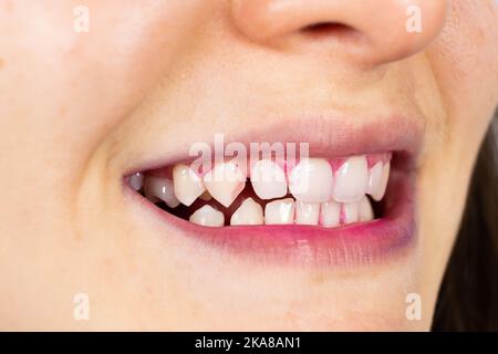 Plaque auf menschlichen Zähnen ist rosa mit Indikatortabletten gefärbt. Stockfoto