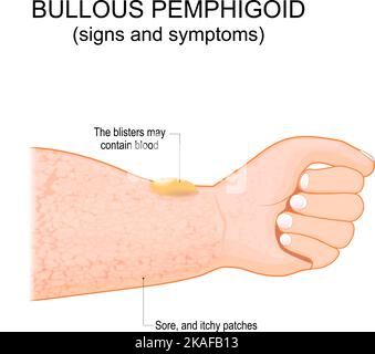 Bullöses Pemphigoid. Autoimmune puritische Hauterkrankung. Hautzustand älterer Menschen. Es beginnt mit einem juckenden Ausschlag, als sich Blasen auf der Haut bilden können Stock Vektor