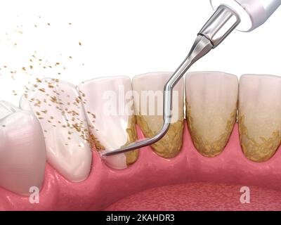 Mundhygiene: scaling und root Planing (konventionelle Parodontaltherapie). Medizinisch genaue 3D-Abbildung der menschlichen Zähne Behandlung Stockfoto