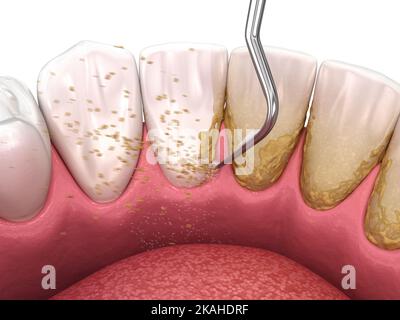 Mundhygiene: scaling und root Planing (konventionelle Parodontaltherapie). Medizinisch genaue 3D-Abbildung der menschlichen Zähne Behandlung Stockfoto