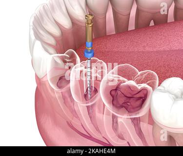 Endodontische Wurzelbehandlung. Medizinisch akkurate Zahn 3D Abbildung. Stockfoto