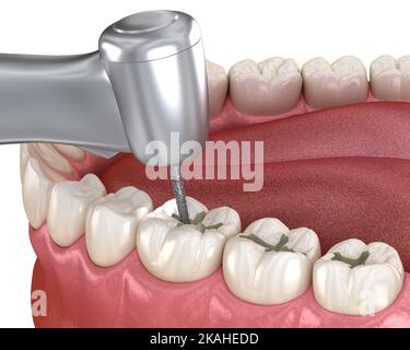 Fissur Vorbereitung für Füllungen Platzierung, medizinisch genaue 3D Illustration des Zahnkonzepts Stockfoto