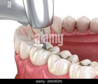 Fissur Vorbereitung für Füllungen Platzierung, medizinisch genaue 3D Illustration des Zahnkonzepts Stockfoto