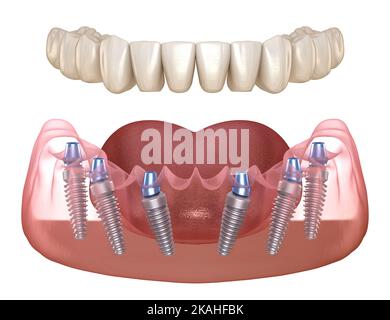 Unterkieferprothese mit Zahnfleisch All ON 6 System unterstützt durch Implantate. Medizinisch akkurate 3D Illustration des menschlichen Zahns und Prothesenkonzepts Stockfoto