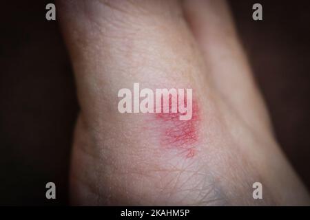 Ameisenbiss auf die Haut des Fußes. Rote Entzündung durch Schädigung der menschlichen Haut. Stockfoto