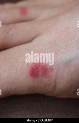 Rote Entzündung durch Schädigung der menschlichen Haut nach einem Insektenstich. Eine Ameise beißt auf die Haut des Fußes. Stockfoto