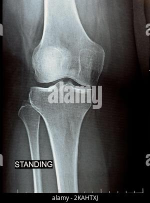 Plain x ray on knee Joint showing joint space narrowing and subchondral Sclerosis on medial compartment (Verdickung des Knochens, die in Gelenken passiert Spreu Stockfoto