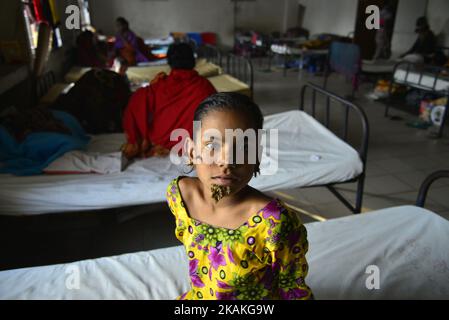 Auf diesem Foto, das am 30. Januar 2017 aufgenommen wurde, posiert der 10-Jahre-Patient aus Bangladesch, Sahana Khatun, für ein Foto am Dhaka Medical College and Hospital. Ein junges Mädchen aus Bangladesch mit rindenähnlichen Warzen, die auf ihrem Gesicht wachsen, könnte die erste Frau sein, die jemals von einem so genannten „Baum-Mann-Syndrom“ betroffen war, sagten Ärzte, die die seltene Erkrankung studierten, im Januar 31. Die zehnjährige Sahana Khatun hat die erzählenden knarrigen Wucherungen, die aus ihrem Kinn, Ohr und ihrer Nase sprießen, aber die Ärzte im Krankenhaus der Medizinischen Hochschule von Dhaka führen immer noch Tests durch, um festzustellen, ob sie an der ungewöhnlichen Hautkrankheit leidet. (Foto von Mamunur Rashid/NurP Stockfoto