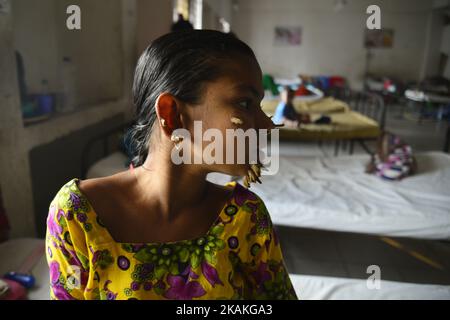 Auf diesem Foto, das am 30. Januar 2017 aufgenommen wurde, posiert der 10-Jahre-Patient aus Bangladesch, Sahana Khatun, für ein Foto am Dhaka Medical College and Hospital. Ein junges Mädchen aus Bangladesch mit rindenähnlichen Warzen, die auf ihrem Gesicht wachsen, könnte die erste Frau sein, die jemals von einem so genannten „Baum-Mann-Syndrom“ betroffen war, sagten Ärzte, die die seltene Erkrankung studierten, im Januar 31. Die zehnjährige Sahana Khatun hat die erzählenden knarrigen Wucherungen, die aus ihrem Kinn, Ohr und ihrer Nase sprießen, aber die Ärzte im Krankenhaus der Medizinischen Hochschule von Dhaka führen immer noch Tests durch, um festzustellen, ob sie an der ungewöhnlichen Hautkrankheit leidet. (Foto von Mamunur Rashid/NurP Stockfoto