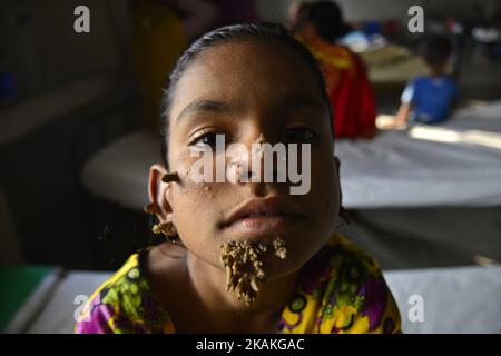 Auf diesem Foto, das am 30. Januar 2017 aufgenommen wurde, posiert der 10-Jahre-Patient aus Bangladesch, Sahana Khatun, für ein Foto am Dhaka Medical College and Hospital. Ein junges Mädchen aus Bangladesch mit rindenähnlichen Warzen, die auf ihrem Gesicht wachsen, könnte die erste Frau sein, die jemals von einem so genannten „Baum-Mann-Syndrom“ betroffen war, sagten Ärzte, die die seltene Erkrankung studierten, im Januar 31. Die zehnjährige Sahana Khatun hat die erzählenden knarrigen Wucherungen, die aus ihrem Kinn, Ohr und ihrer Nase sprießen, aber die Ärzte im Krankenhaus der Medizinischen Hochschule von Dhaka führen immer noch Tests durch, um festzustellen, ob sie an der ungewöhnlichen Hautkrankheit leidet. (Foto von Mamunur Rashid/NurP Stockfoto