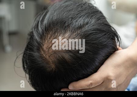 Glatze in der Mitte Kopf und beginnen keinen Verlust Haar glabrous der reifen asiatischen Geschäft smart aktiven Büromann. Stockfoto